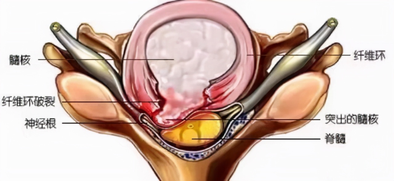 腰间盘突出没有保守治疗直接微创,腰间盘突出症不花钱自我康复疗法