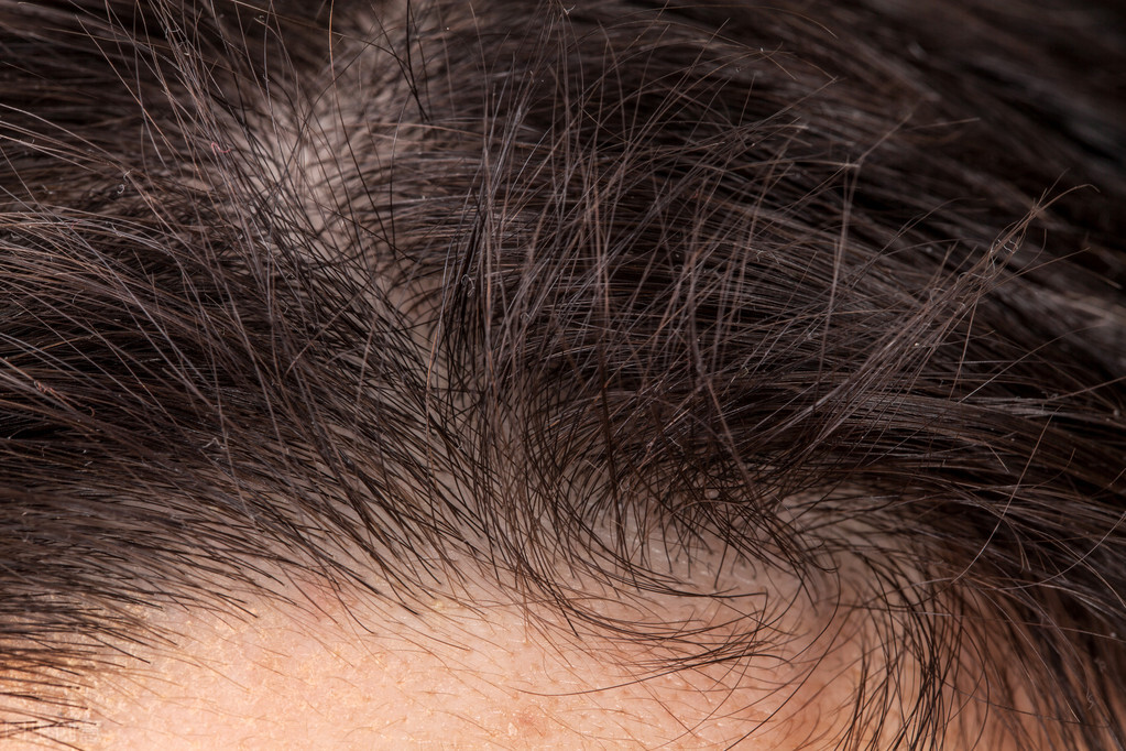 头皮爱出油教你几个小方法,男士头皮出油用什么洗发水控油