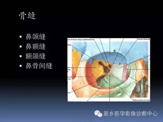 鼻骨骨折在ct片上的表现,鼻骨骨折ct怎么看