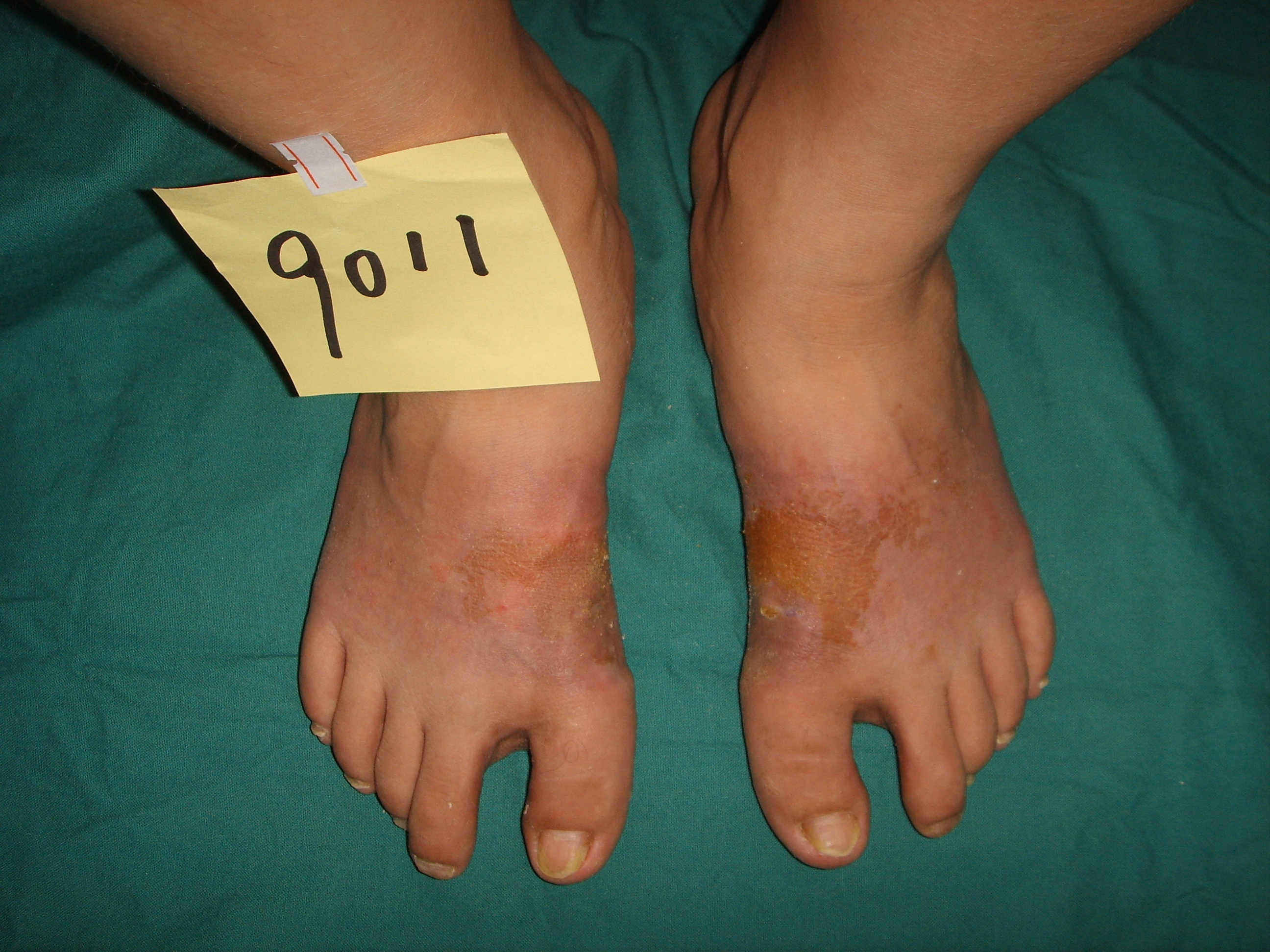 脚拇指外翻手术后还会遗传吗,遗传性拇外翻需要做手术么