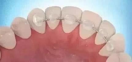 牙齿矫正如何预防反弹,牙齿矫正后反弹有什么补救方法