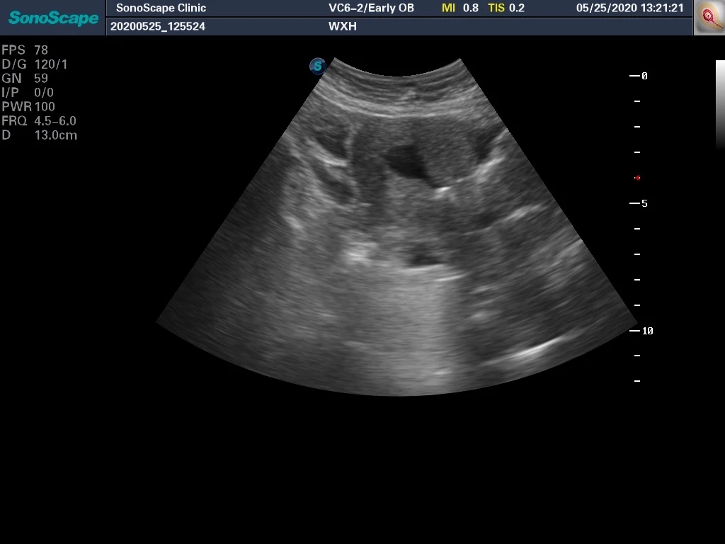 轻微宫腔粘连手术成功案例,轻度宫腔粘连分离术是大手术吗