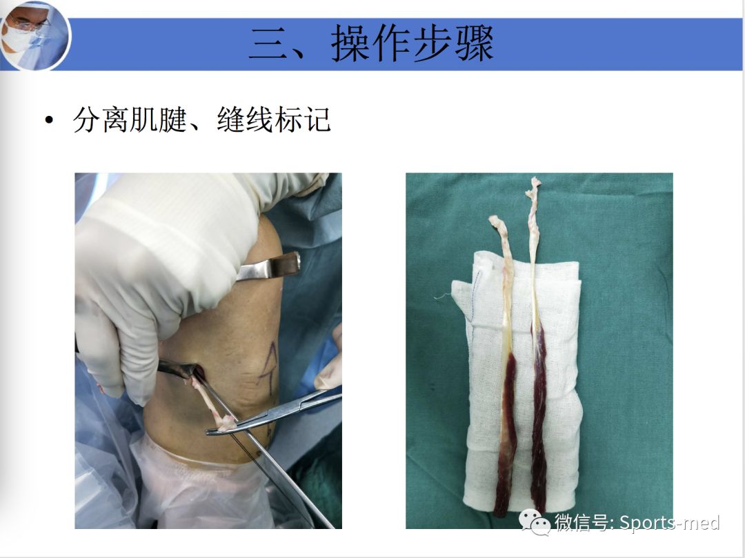 案例分享痴迷足球的十六岁男孩如何战胜十字韧带伤痛重返赛场