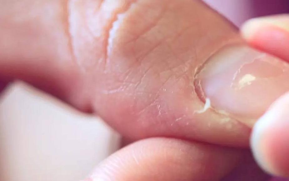 手上起倒刺缺乏什么维生素,手上倒刺最简单的去除方法
