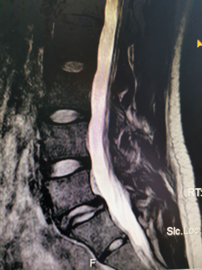腰椎滑脱的治疗方法,腰椎滑脱手术医保多少钱