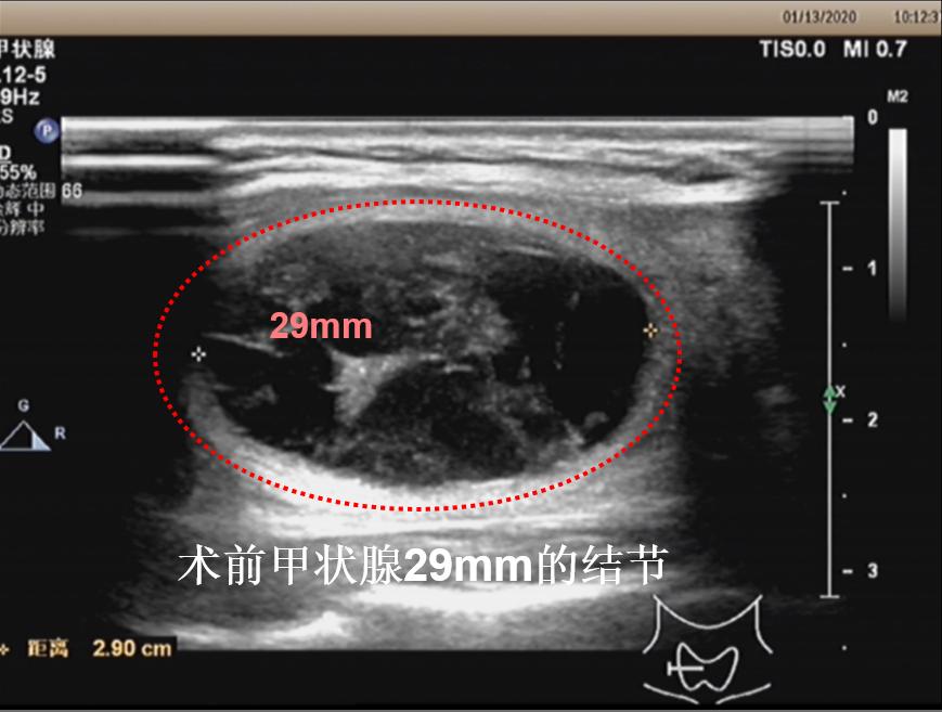 甲状腺结节微创消融手术,甲状腺结节微创消融医保
