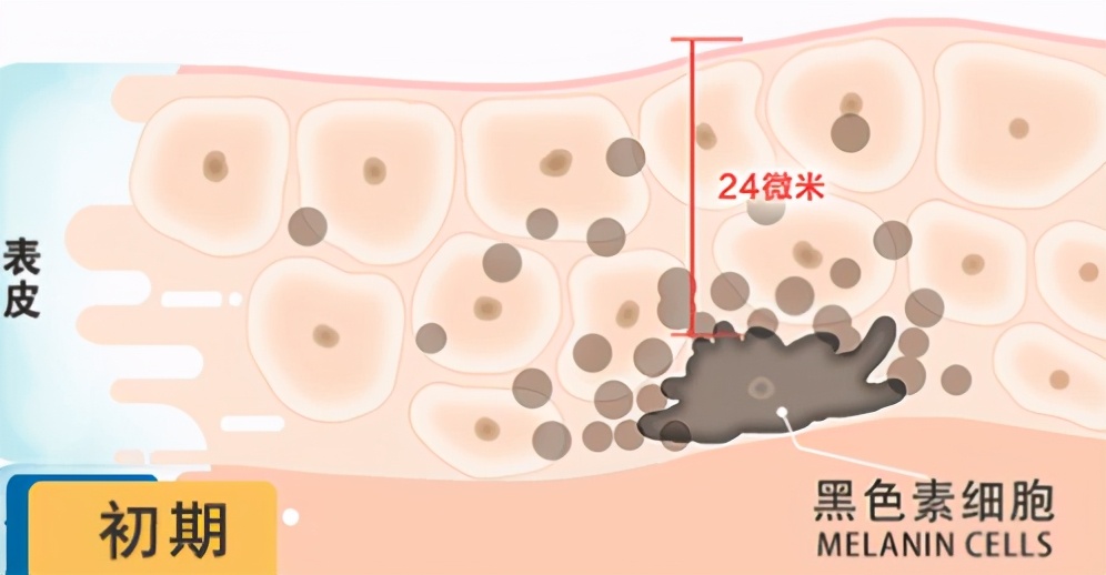 什么样的斑适合激光祛斑,青褐斑可以用激光吗