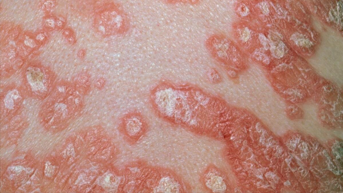 牛皮癣患者多吃哪些蔬菜有好处呢,牛皮癣可以吃的水果都有哪些