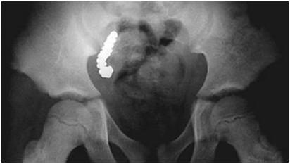 阑尾里边有粪石需要及时手术吗,阑尾粪石会引起异物感么