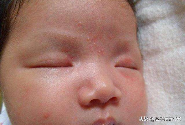 婴儿脸上起疹子跟母乳有关系吗,婴儿脸上有小疹子颗粒怎么消除