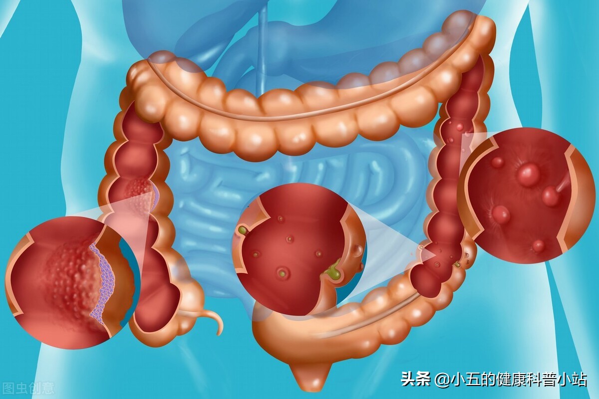 结肠息肉最好的手术方法有几种,做一个结肠息肉手术大约要多少钱