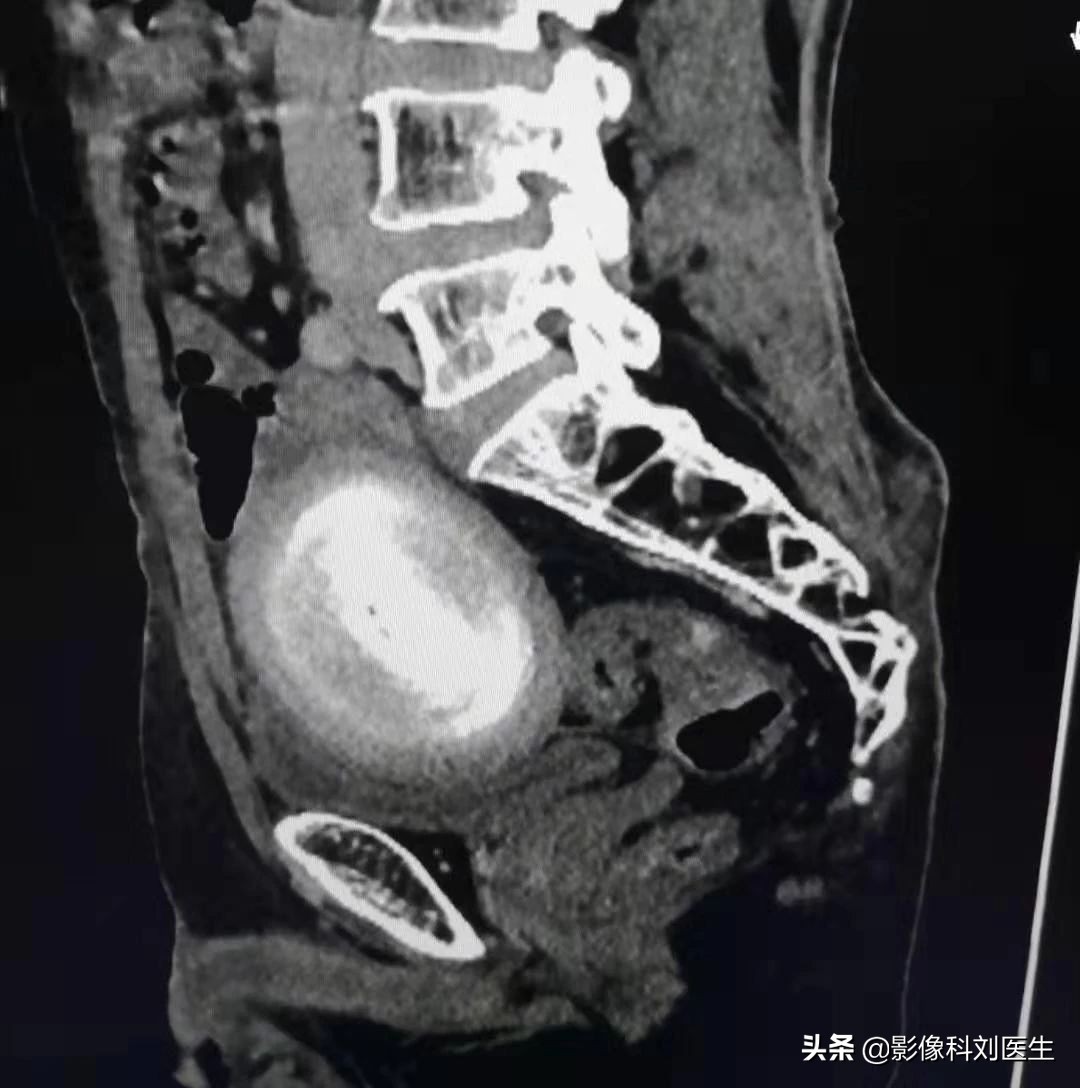 鸭蛋吃多了肚胀气有什么办法,鸭蛋烂在肚子里怎么办