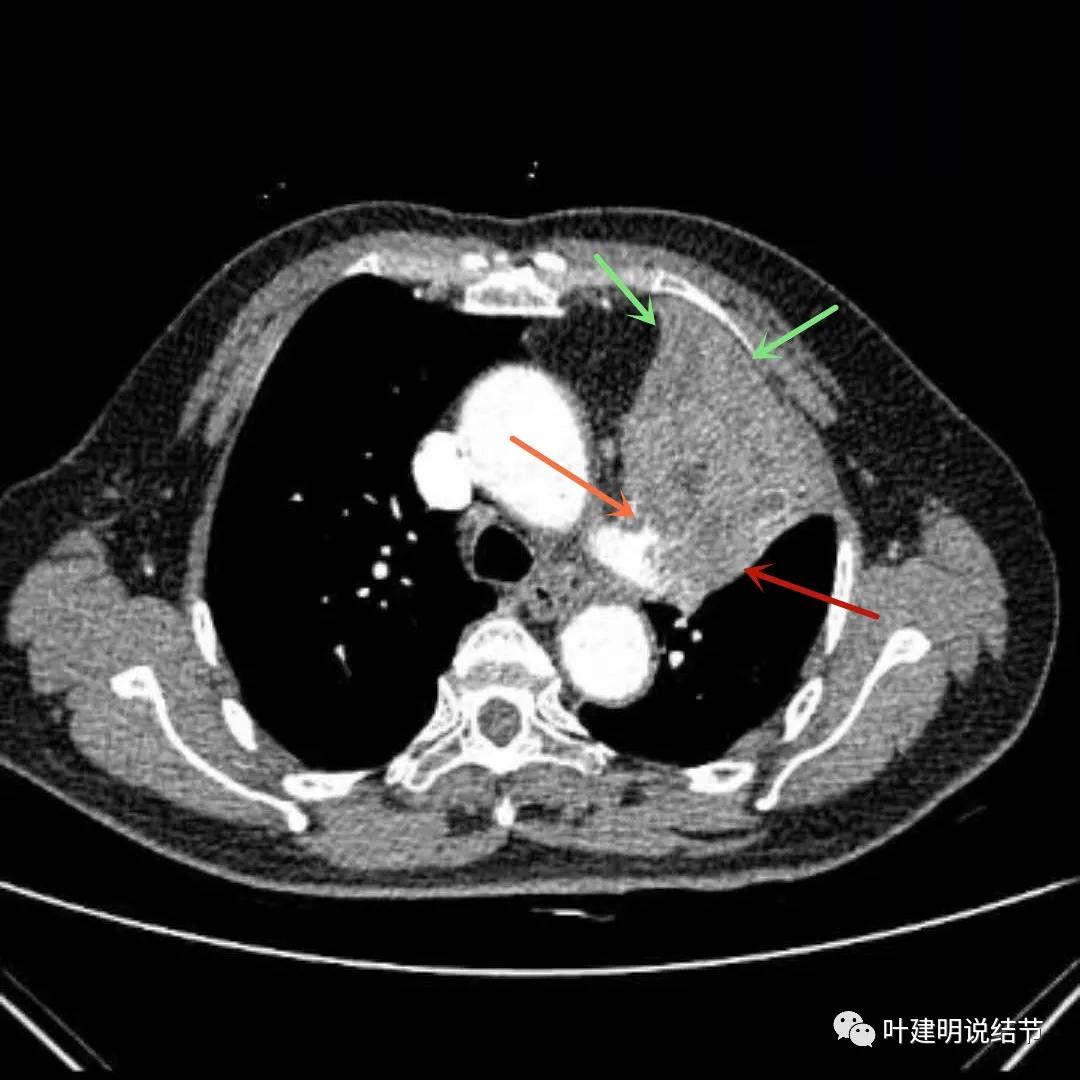 高龄肺癌靶向治疗效果,高龄老人肺癌早期适合放疗吗