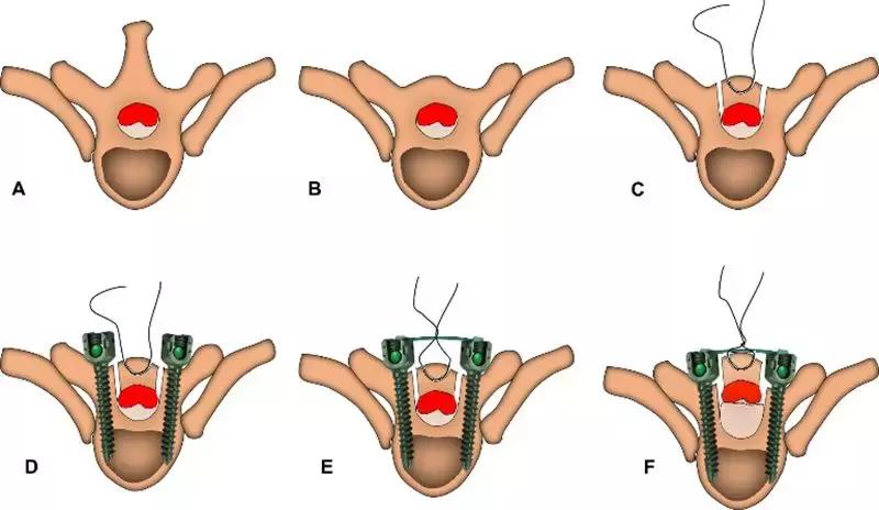 胸椎黄韧带骨化的治疗方法,胸椎黄韧带骨化症手术效果如何