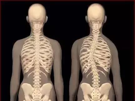孩子发现脊柱侧弯该怎么办,十七岁女孩发现脊柱侧弯怎么办