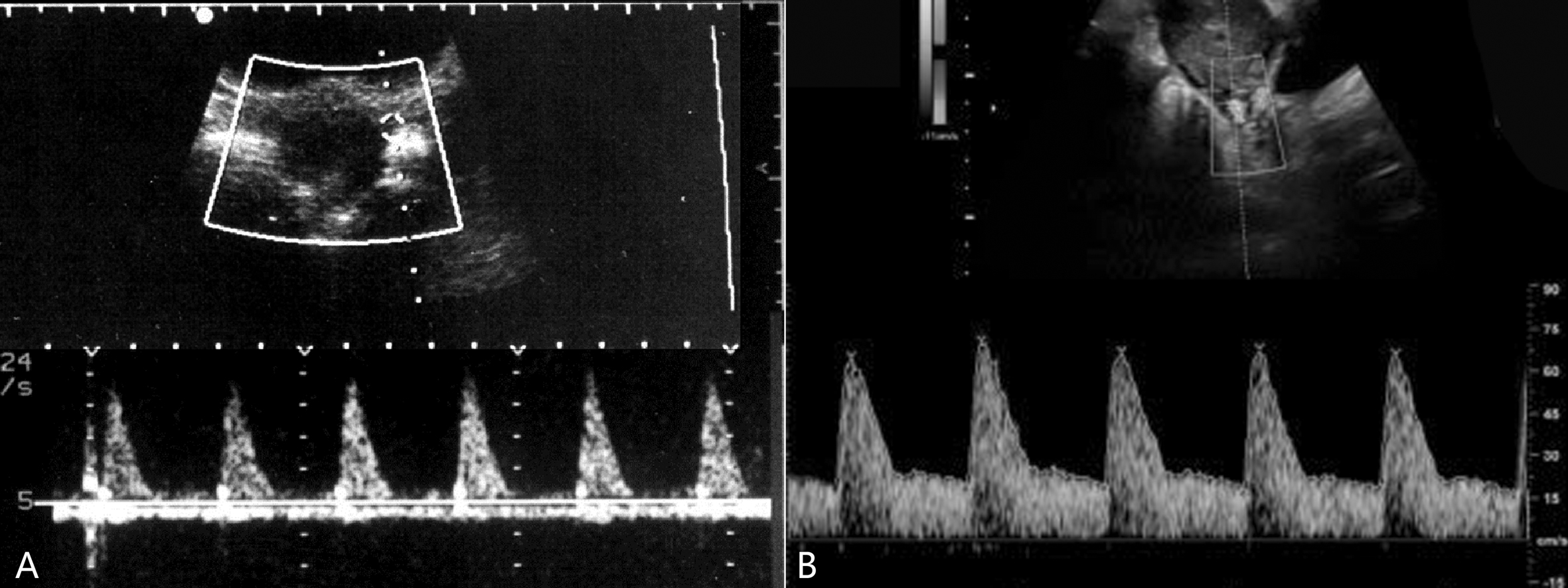 盆腔血管彩色多普勒超声孕期检查,明明白白做ct检查