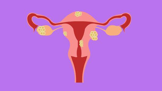 子宫肌瘤癌变怎么办？要切除子宫吗？听听妇科医生怎么说的