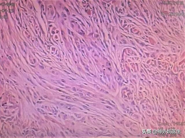 脑膜瘤是什么原因引起的啊,脑膜瘤手术治疗全部大概多少钱