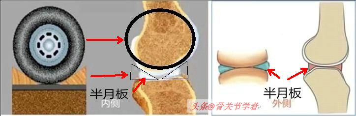 磁共振图片讲解半月板损伤的程度,磁共振半月板损伤严重
