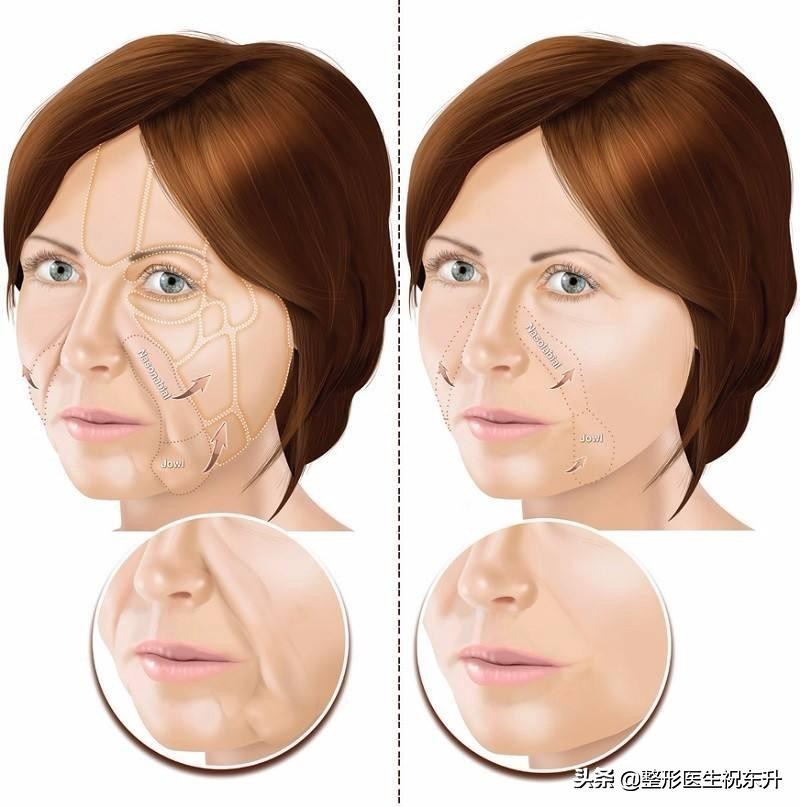 法令纹怎么去除男生不会有副作用,去除法令纹最安全有效的方法