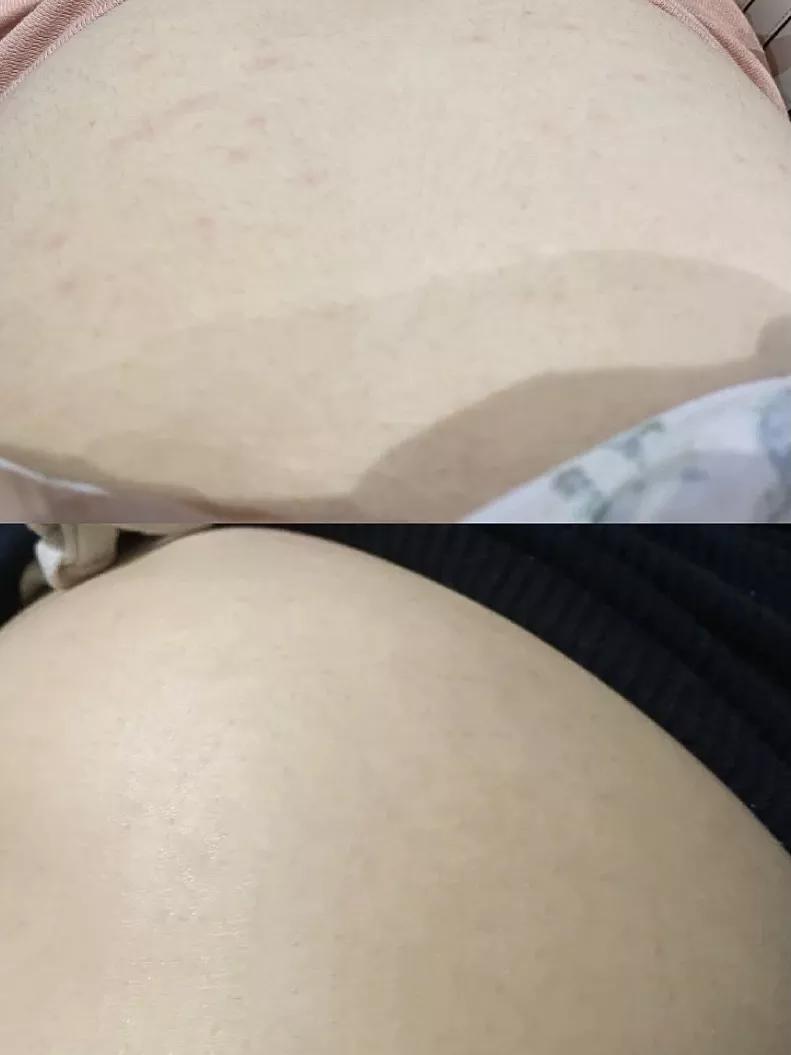 辣妈孕期美丽秘籍3招长胎不长纹,孕期一条妊娠纹不长是怎样做到的