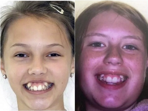 王俊凯整牙日记完整版,王俊凯的小虎牙为什么磨平了