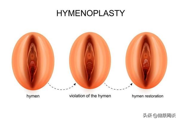 怕破坏处女膜，医生拒绝做妇科手术，这层膜真这么重要？