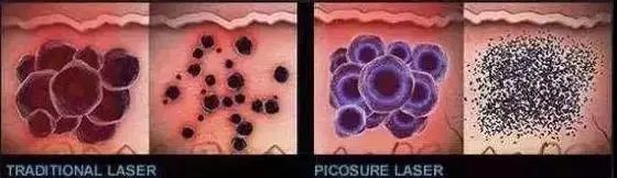 神乎其技的针灸手法,皮秒仪器什么样子