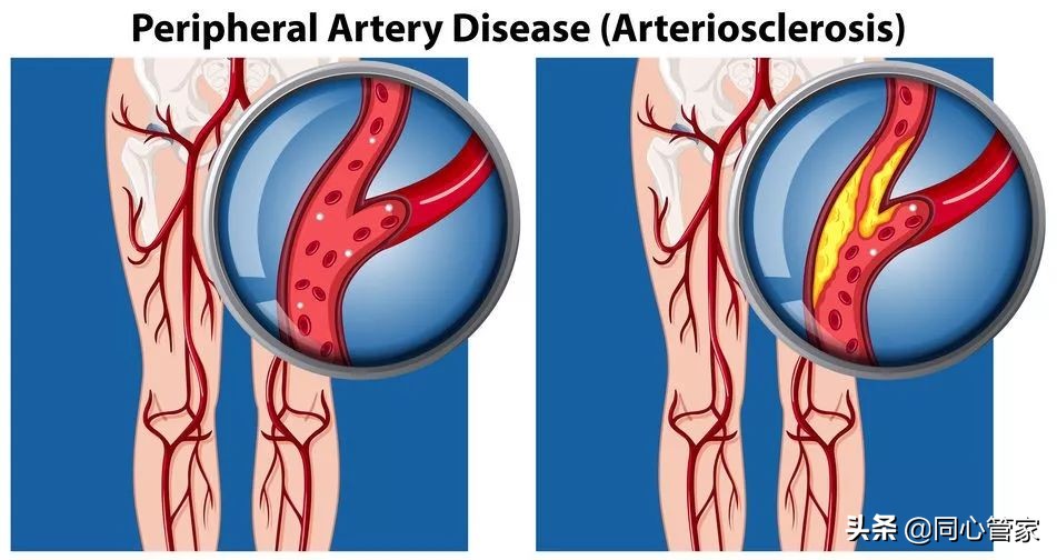 血管狭窄如何扼住生命的咽喉？让你全身器官都遭殃