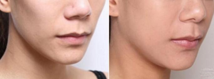 自体脂肪面部填充，让你的脂肪“动起来”