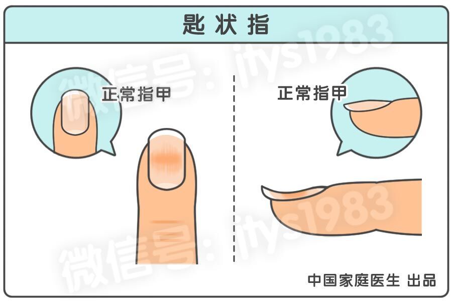 指甲全是竖条纹和白点是怎么回事,指甲竖条纹没有月牙怎么回事