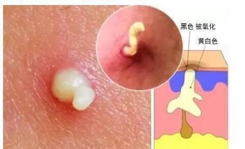 为什么挤黑头伤毛孔,为什么挤黑头时间长了心慌