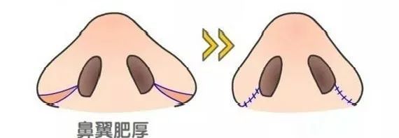 鼻翼缩小内缩和外缩的区别,鼻头缩小和鼻翼缩小是一个手术吗
