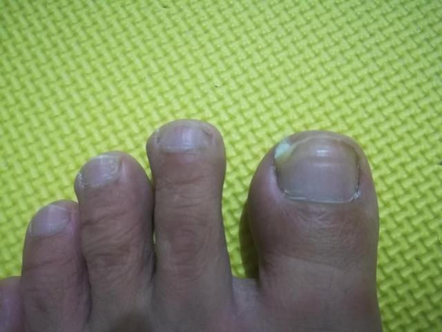 甲沟炎自愈的经历,甲沟炎的亲身经历