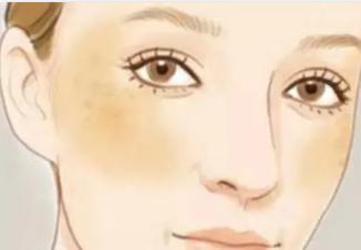 色斑有几种如何去区分,色斑在医院挂什么科