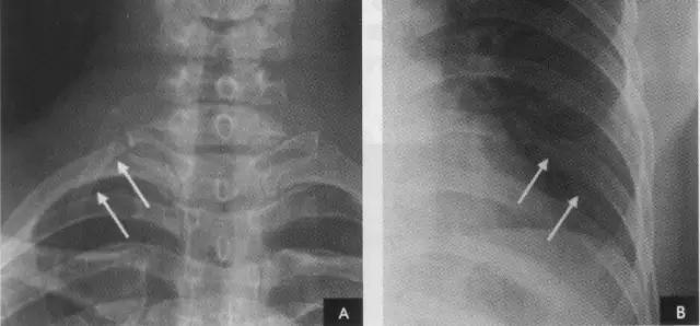 收藏：详细的胸部X线解剖，最基础最实用