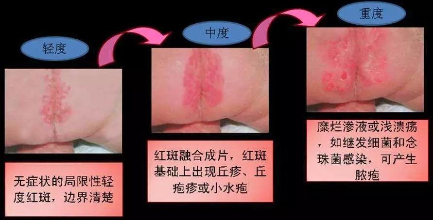 婴儿尿布湿疹的最快自愈方法,婴儿湿疹痤疮尿布疹