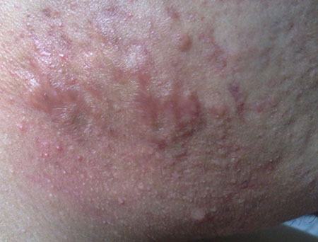 如何分辨痘痘的类型和长痘的原因,如何判断自己长的痘痘是哪种痘痘