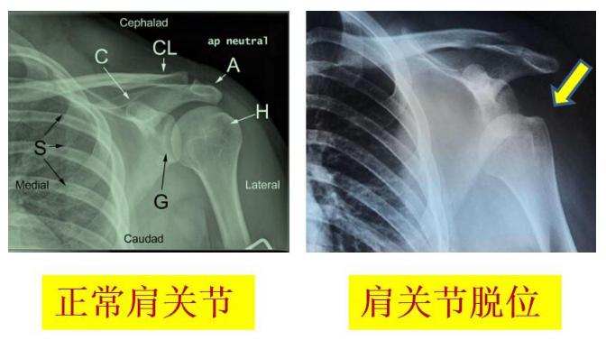 习惯性肩关节脱位怎么办,怎么检查肩关节是不是习惯性脱位