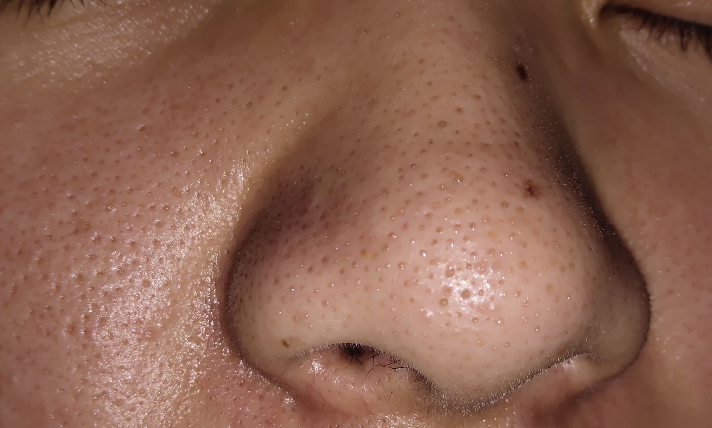 黑头如果不管的话会怎样,如果黑头一直不挤会怎样