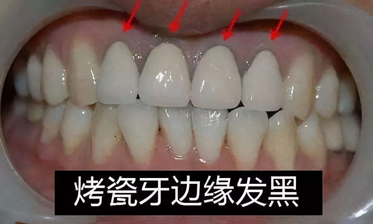 有多少人做了烤瓷牙后悔呀,为什么越来越多人放弃烤瓷牙