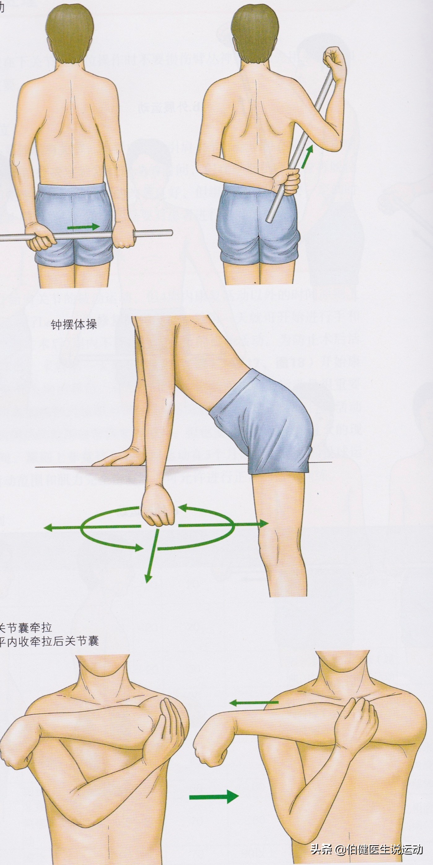 肩袖三级撕裂保守治疗效果,肩袖撕裂保守治疗的方法