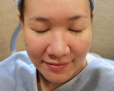 毛孔粗大如何改善真实有效,毛孔粗大收缩毛孔最科学的方法