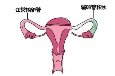 关于输卵管积水，你了解多少？