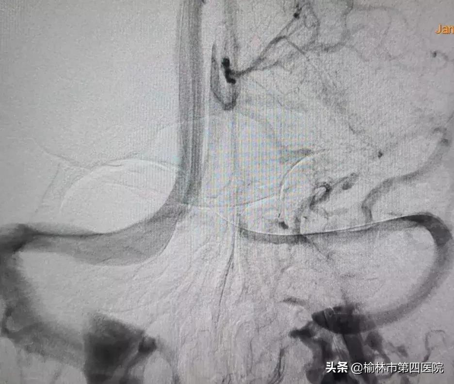 成功开展内瘘狭窄球囊扩张术,静脉窦狭窄手术