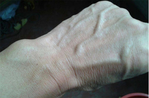 头部血管突出青筋暴起是什么原因,头部青筋