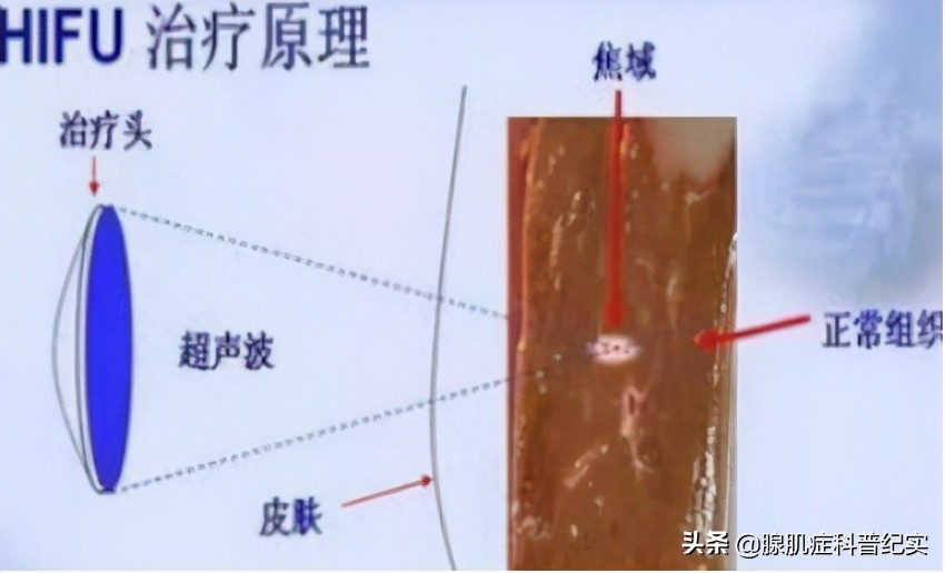 这4种手术治疗腺肌症的利弊你知道吗?
