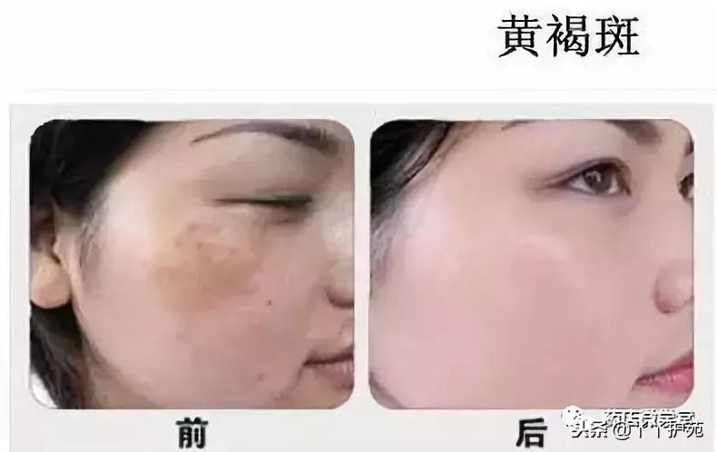 褐斑最好的消除药,褐青斑与黄褐斑的治疗费用