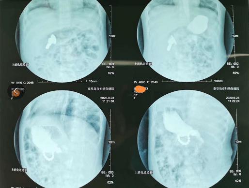 磁力珠与硬币在女童腹内邂逅逞凶 秦皇岛妇幼专家呼吁家长:别给幼儿买危险玩具