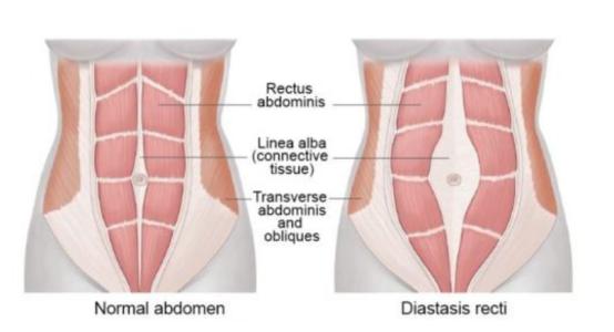 新妈妈产后便秘怎么办,产后妈妈漏尿是什么原因造成